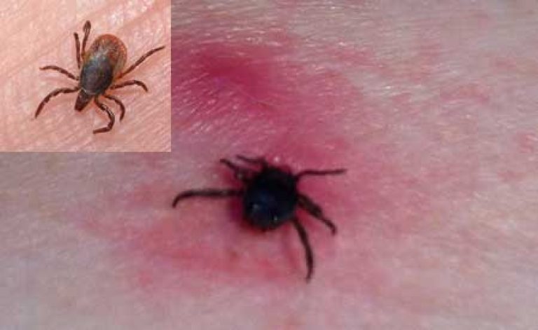 Tick \u200b\u200bbites - the first signs, symptoms in a person, what a bite looks like, consequences and prevention
