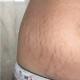 How to get rid of stretch marks (stretch marks), effective methods for removing and preventing stretch marks