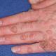 Warts: causes and treatment methods