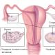 Pengobatan sindrom ovarium polikistik - apakah mungkin untuk menghilangkan penyakit ini selamanya?