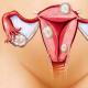 Tanda-tanda moma uterus, bagaimana cara mengenali?