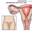 Salpingitis, ¿qué es?