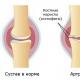 관절염에 대한 정형 무릎 보조기 : 유형, 비용, 선택 및 작동 규칙