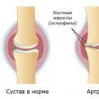 Ortopedski steznik za koljeno za artrozu: vrste, cijena, pravila za odabir i rad