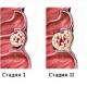 Rak debelog crijeva: prvi simptomi, kako se razvija u ranim fazama, dijagnoza i liječenje